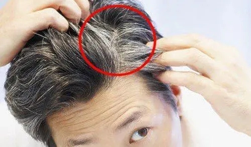 两鬓有白发是什么原因呢?应如何预防呢？